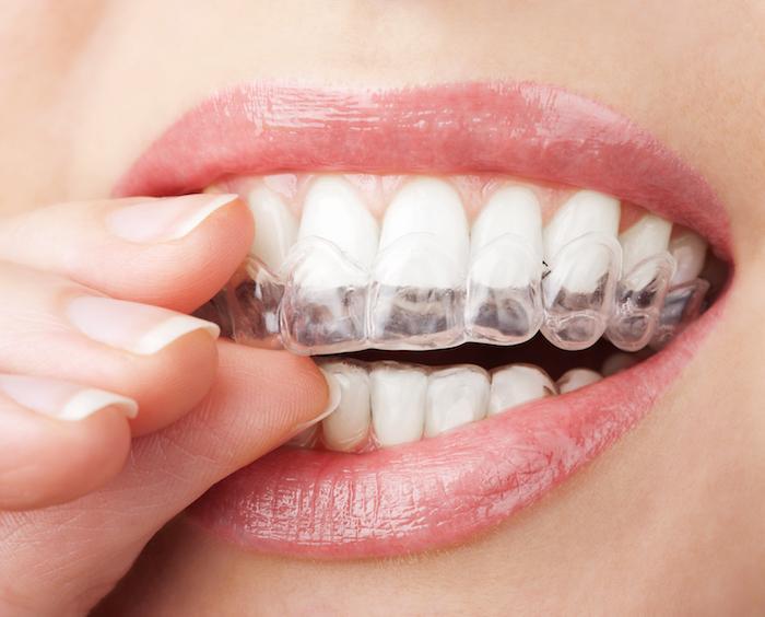 Benefits of Invisalign Treatment