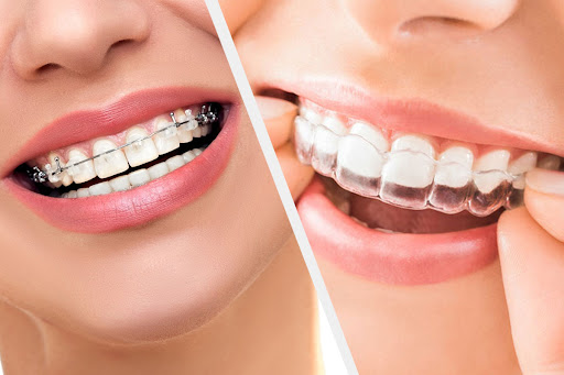 Life with Invisalign