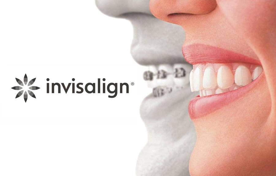 Smooth Experience with Invisalign Braces